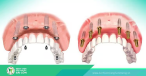 Địa chỉ nha khoa uy tín tại Quận 5 có bảng giá trồng răng tốt nhất dia-chi-nha-khoa-uy-tin-tai-quan-5