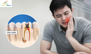 Nhổ răng khôn bị sốt: Xử lý thế nào cho tốt? Nhổ răng khôn bị sốt