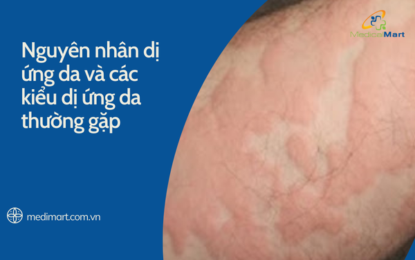 Nguyên nhân dị ứng da và các kiểu dị ứng da thường gặp