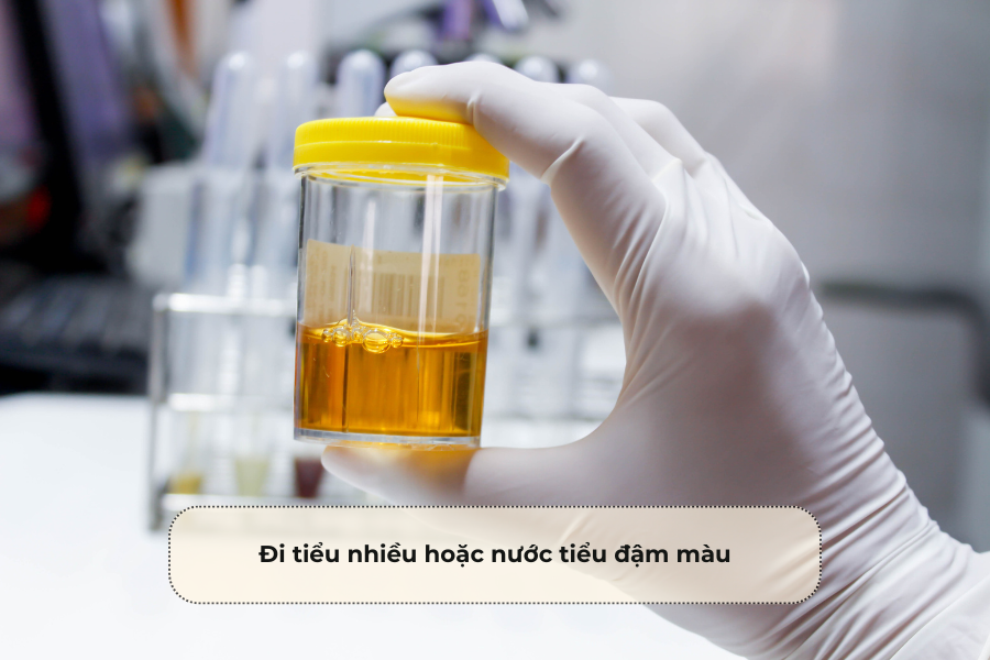 Đi tiểu nhiều hoặc nước tiểu đậm màu