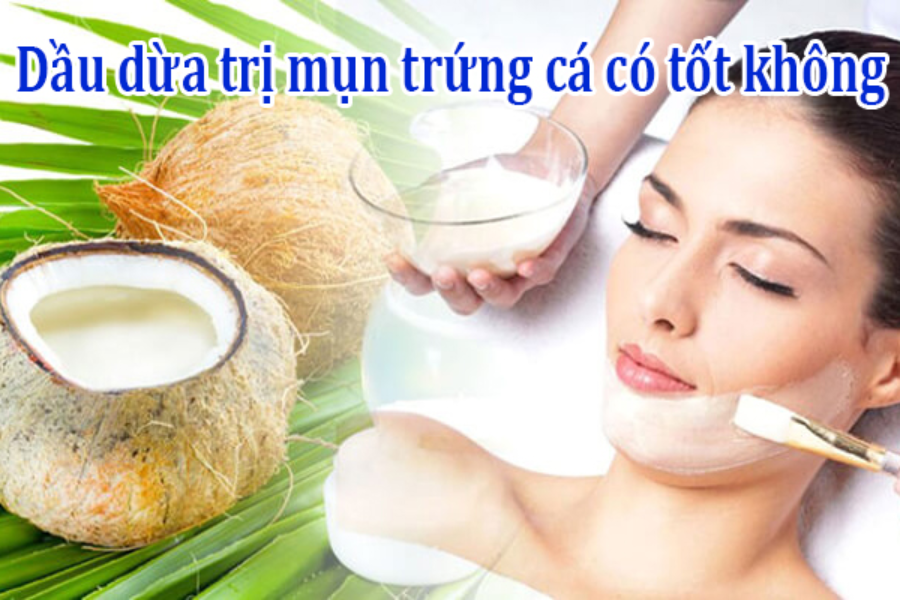 Dầu dừa có trị mụn trứng cá không​