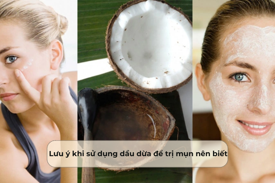 Lưu ý khi sử dụng dầu dừa để trị mụn nên biết