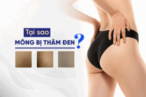 Tại sao mông bị thâm đen_ Nguyên nhân và giải pháp từ góc nhìn chuyên gia