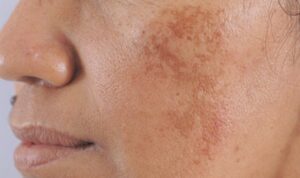 Cách chăm sóc da sau laser trị nám để hạn chế thâm sạm trở lại cach-cham-soc-da-sau-khi-laser-tri-nam