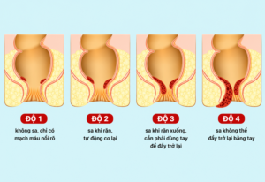 Bệnh trĩ có cần phẫu thuật hay không? Những trường hợp nên và không nên phẫu thuật Phân loại các cấp độ của bệnh trĩ để đánh giá mức độ nặng nhẹ