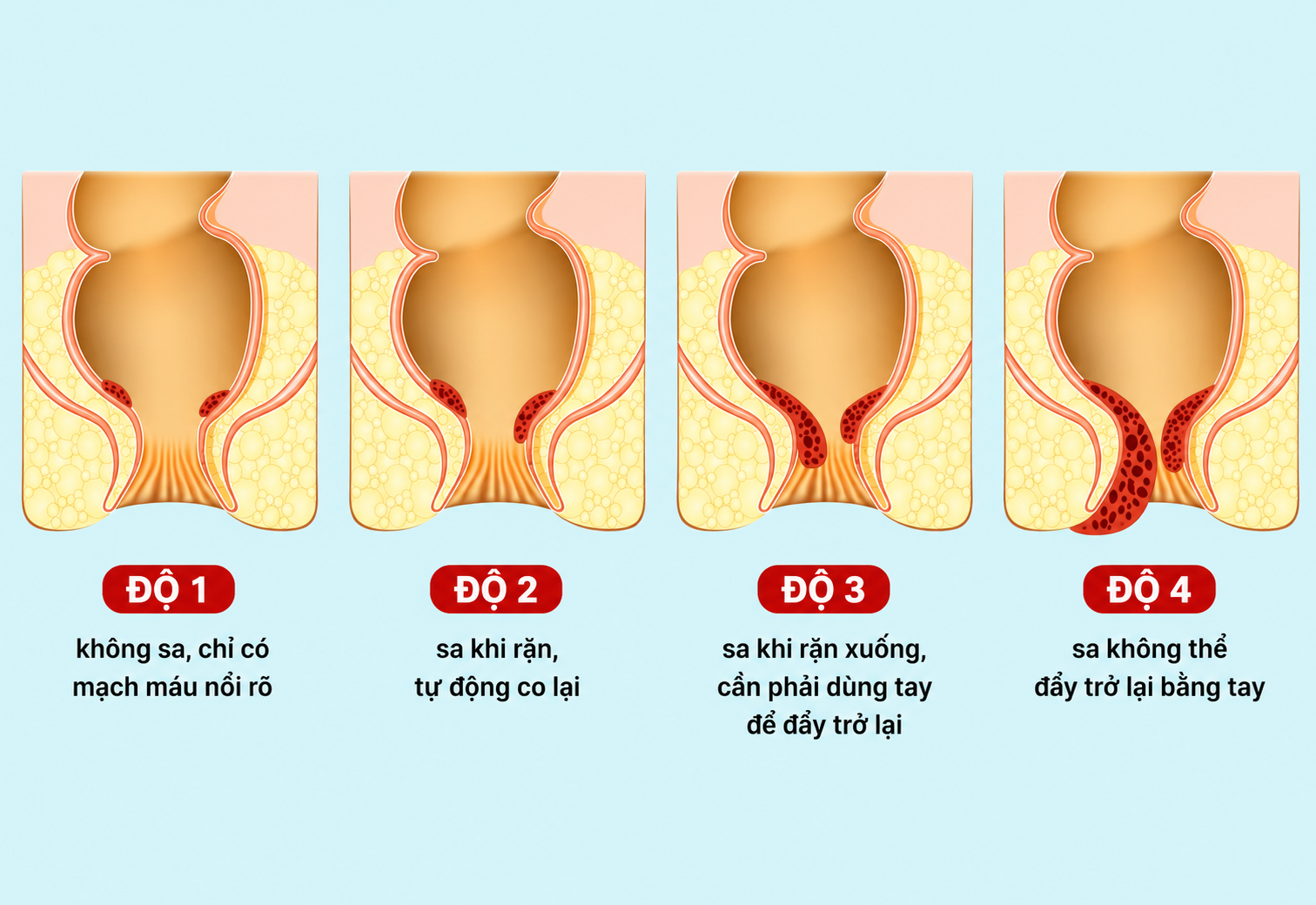 Phân loại các cấp độ của bệnh trĩ để đánh giá mức độ nặng nhẹ