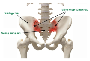 Viêm khớp cùng chậu có chữa khỏi được không? Nên khám và điều trị ở đâu? Vị trí viêm khớp cùng chậu
