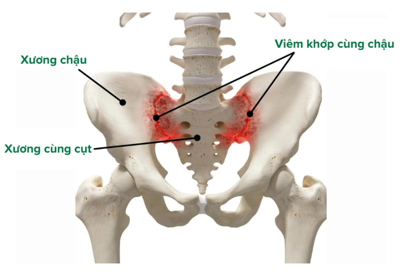 Vị trí viêm khớp cùng chậu
